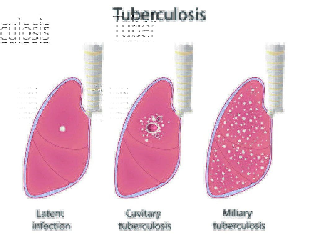 Tuberculosis Doctors